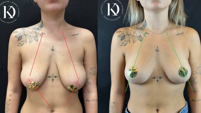 MY breasts hung without childbirth or breastfeeding - NSFW, My, Doctors, The medicine, Video, Soundless, Longpost, Girl with tattoo