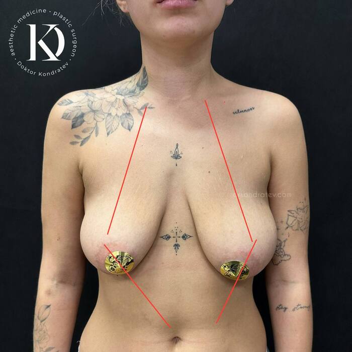 MY breasts hung without childbirth or breastfeeding - NSFW, My, Doctors, The medicine, Video, Soundless, Longpost, Girl with tattoo